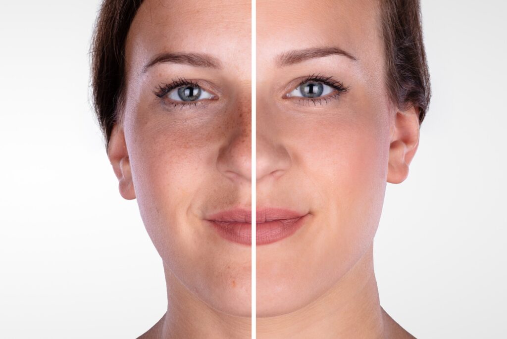 Before and After Laser Resurfacing - Dermatologist Marketing
