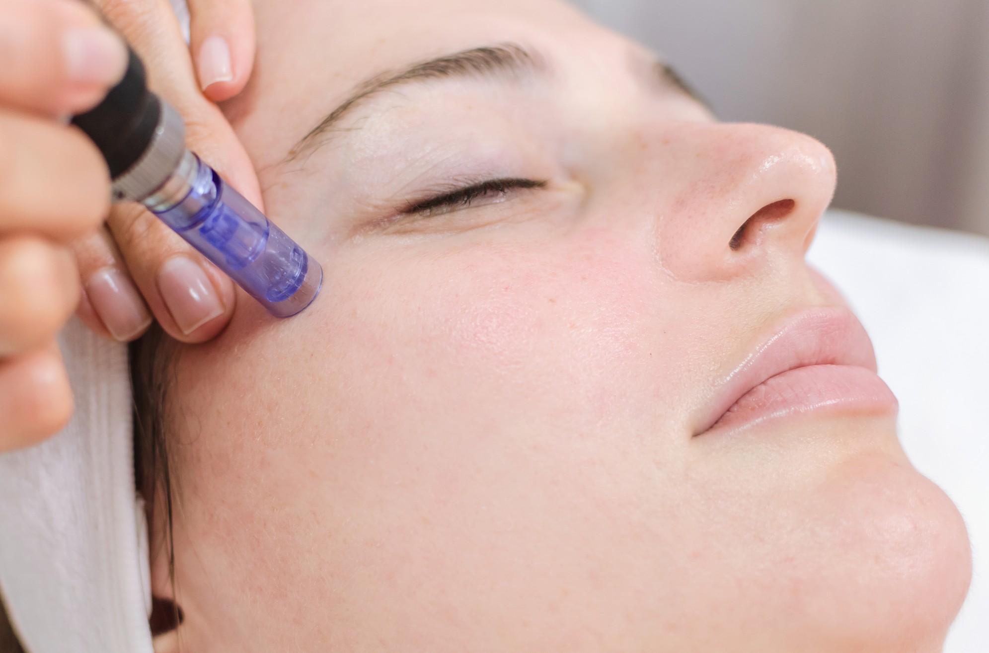 microneedling dermatologist treatment