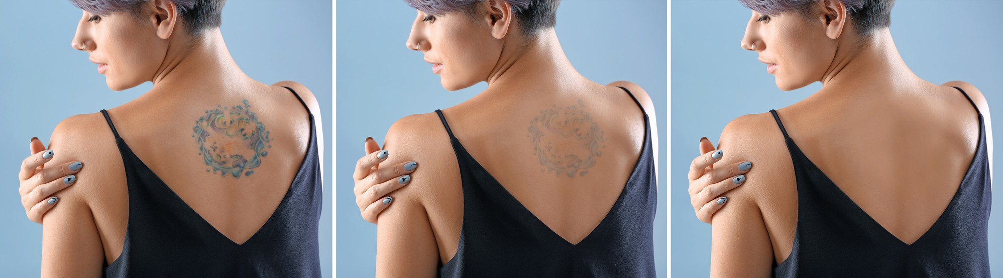 Tattoo Removal - Dermatologist Marketing Services